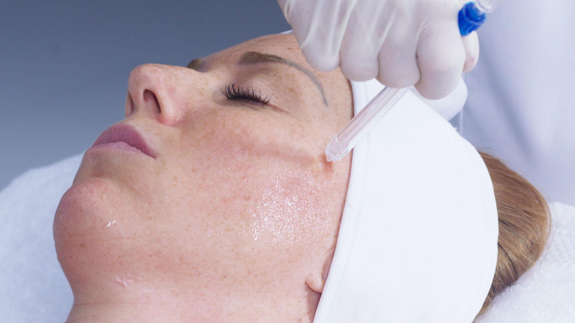 Soin du visage Jet Peel au cabinet Poesia